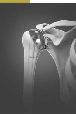Picture of Joint Replacement