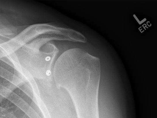Picture of X rays showing latarjet fixed with a suture button - 1