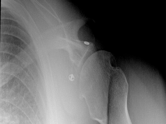 Picture of X rays showing latarjet fixed with a suture button - 2