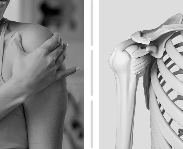Picture of Massive Rotator Cuff Tears
