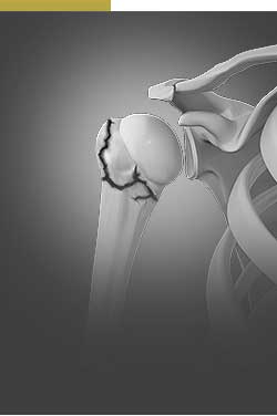 Picture of Shoulder Injuries