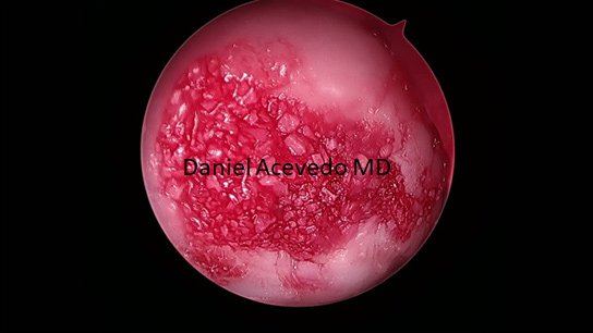 Picture of Arthroscopic Application of BioCartilage