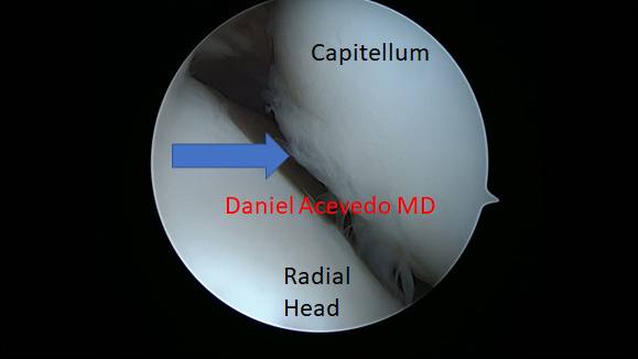 Picture of Arthroscopic view of the Anterior ellbow compartment