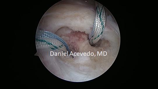 Picture of Bio Absorbable suture anchors
