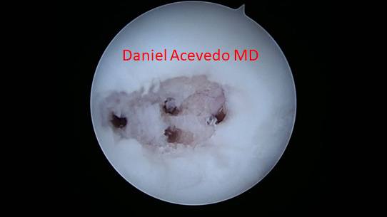 Picture of The cartilage lesion has been cleaned up
