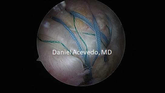 Picture of Completed double row repair