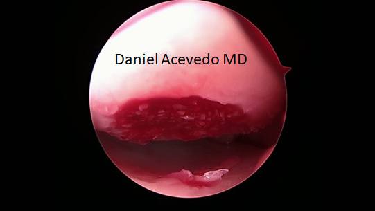 Picture of Final treatment showing a filled defect
