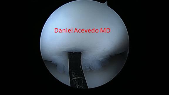 Picture of probe is identifying the cartilage lesion