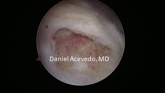 Picture of Shoulder seen here after tendon