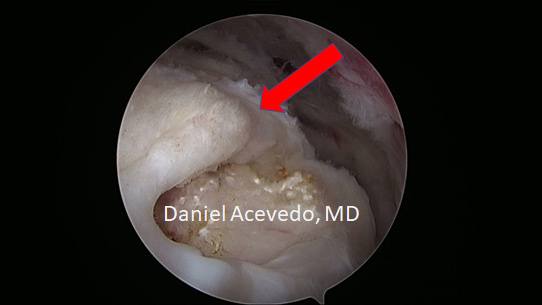 Picture of This depicts a Supra and Infraspinatus tendon tear