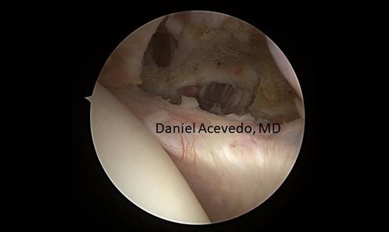 Picture of release of the interval tissue