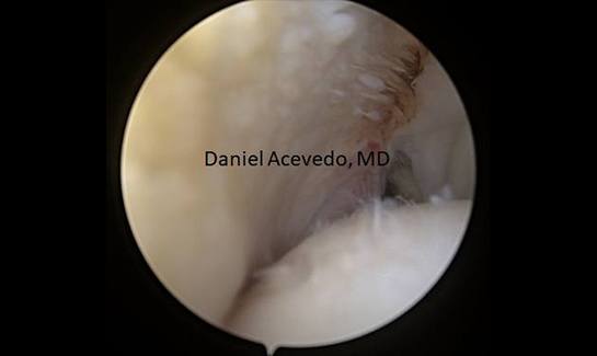 Picture of Remplissage procedure was performed