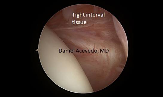 Picture of Arthroscopic View of the anterior shoulder