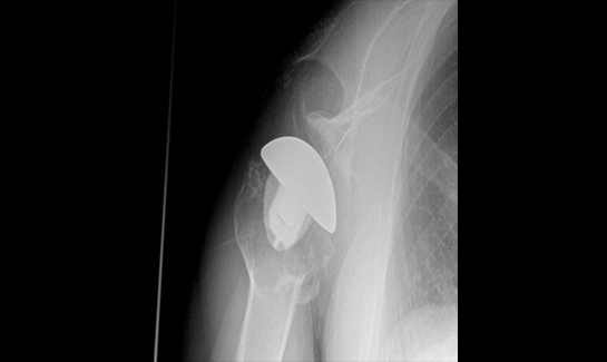 Picture of Axillary view x-ray after TSA