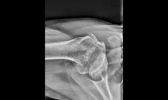 Picture of Axillary view x-ray showing bone