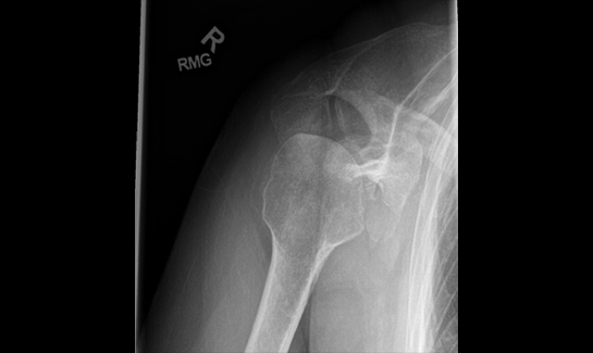Picture of Axillary x-ray view