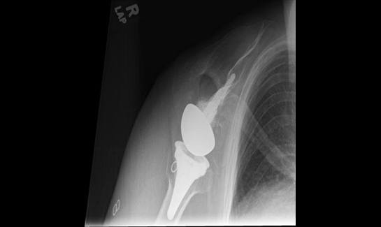 Picture of Axillary x-ray view of RSA