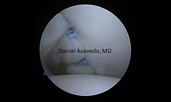 Picture of Ligament Plication anteriorly