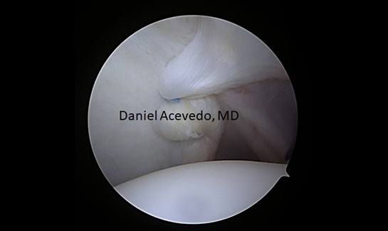Picture of Ligament Plication decreasing capsular volume posteriorly