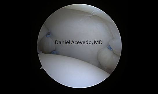 Picture of Completed Arthroscopic Capsular plication