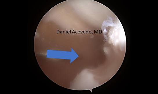Picture of Engaging Hill Sachs lesion