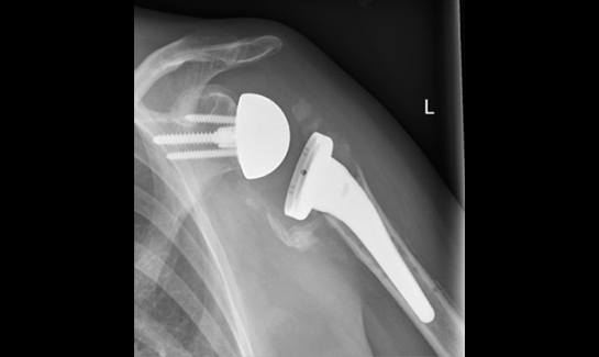 Picture of Failed reverse shoulder with humeral bone loss