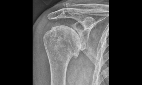 Picture of Grashey view X-ray
