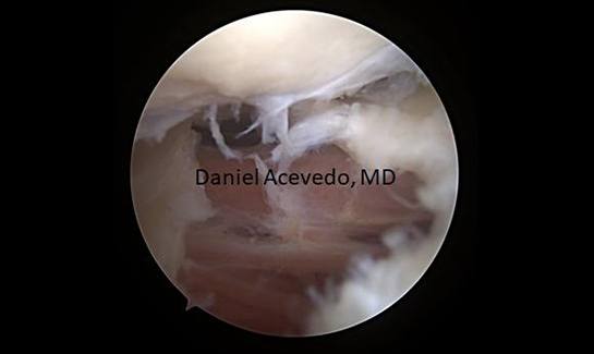 Picture of Inferior capsule release has been performed