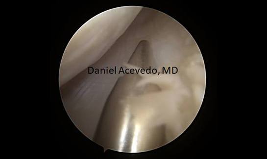Picture of Inferior capsule view with metallic probe