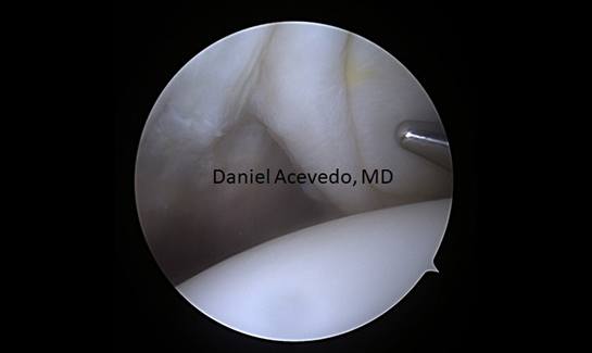Picture of Left shoulder Arthroscopic view