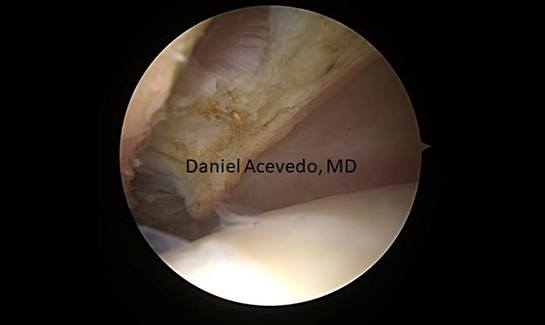 Picture of Posterior capsule has been released