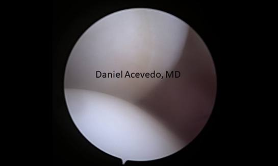 Picture of Posterior labrum flattening