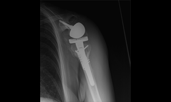 Picture of Reverse shoulder now stable and reduced