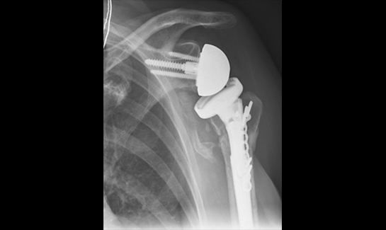 Picture of Reverse shoulder replacement with bone loss