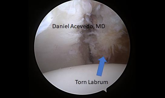 Picture of Right shoulder anterior inferior