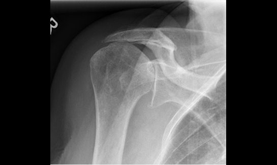 Picture of Right shoulder with rotator cuff arthropathy