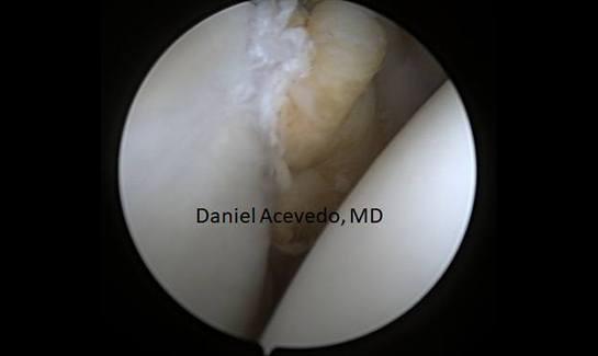 Picture of The labrum and ligament has been repaired