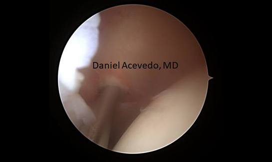 Picture of Tight inflamed posterior capsule tissue