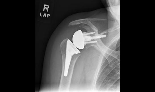 Picture of X-ray after RSA