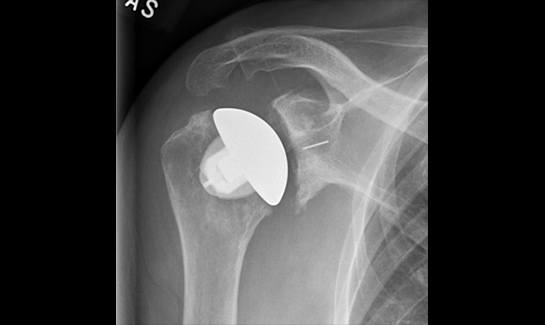 Picture of X-ray of Stemless TSA