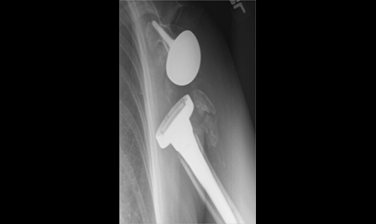 Picture of X-ray showing anterior dislocation