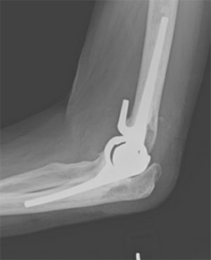 Complex Elbow Surgeon