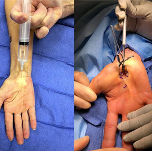 Wide-Awake Hand Surgery (WALANT)/ In-Office Hand Surgery