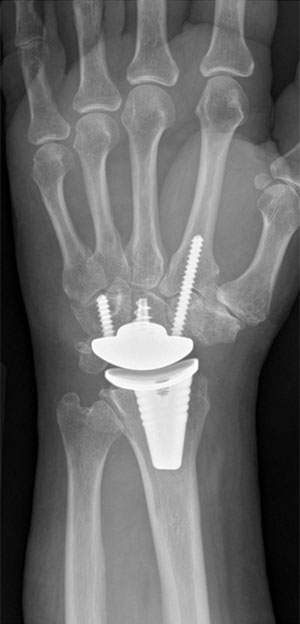 Wrist Surgery Specialist