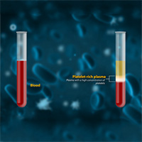 Platelet-Rich Plasma