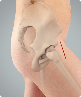 Anterior Hip Replacement Icon
