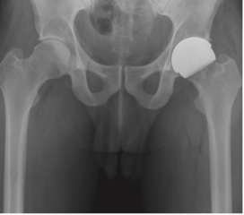 Birmingham, Adept and Ceramic Hip Resurfacing
