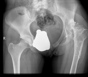 Complex hip replacement logo1