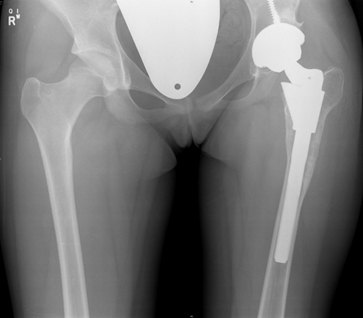 Complex hip replacement logo2