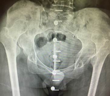 Complex hip replacement logo3